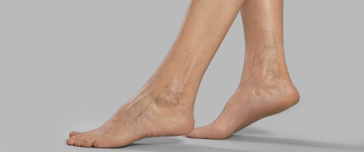 Derin Ven Trombozu Belirtileri Nelerdir